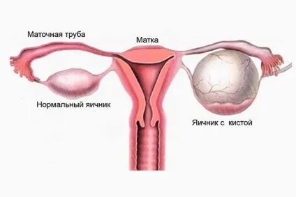 Цистаденома яєчника (муцинозная, серозна, папілярна) методи лікування, прогнози (методи) Цистаденома яєчника (муцинозная, серозна, папілярна) методи лікування, прогнози