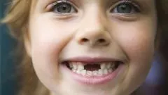 Як розхитати зуб - якщо хитається корінний зуб - здоров'я і медицина - інше (як розхитати зуб) Як розхитати зуб - якщо хитається корінний зуб - здоров'я і медицина - інше