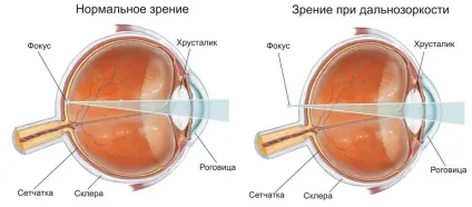 Далекозорість як відновити зір (зір) Далекозорість як відновити зір