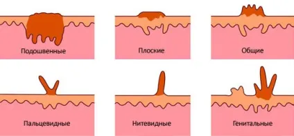 Електрокоагуляція папілом відгуки, що це таке, протипоказання та можливі ускладнення (папілом) Електрокоагуляція папілом відгуки, що це таке, протипоказання та можливі ускладнення