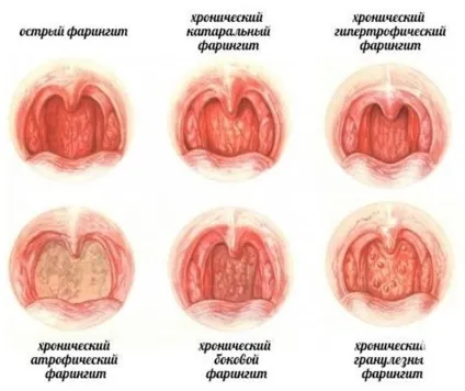 Фарингіт - лікування хвороби