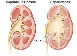 Гідронефроз у дітей - лікування гідронефрозу нирок у дитини (дитини) Гідронефроз у дітей - лікування гідронефрозу нирок у дитини