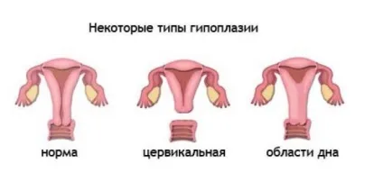 Гіпоплазія матки ознаки, ступеня і лікування патології, чи можна завагітніти при інфантильному (ознаки) Гіпоплазія матки ознаки, ступеня і лікування патології, чи можна завагітніти при інфантильному