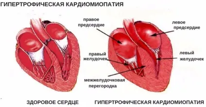 Гіпертрофтческая кардіоміопатія у кішок симптоми, лікування, в тому числі у британських кішок, скільки (кардіоміопатія) Гіпертрофтческая кардіоміопатія у кішок симптоми, лікування, в тому числі у британських кішок, скільки