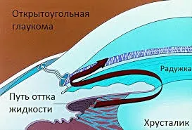Глаукома причини, симптоми, лікування і профілактика, очі і зір (глаукома) Глаукома причини, симптоми, лікування і профілактика, очі і зір