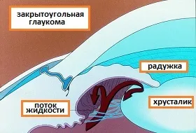 Глаукома причини, симптоми, лікування і профілактика, очі і зір (глаукома) Глаукома причини, симптоми, лікування і профілактика, очі і зір