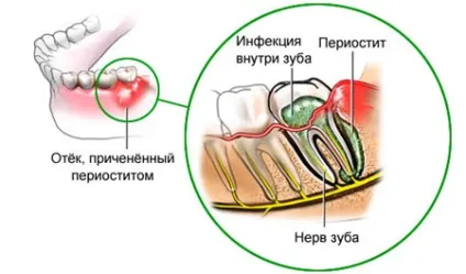 Гнійний періостит симптоми і методи лікування гострого запалення (лікування) Гнійний періостит симптоми і методи лікування гострого запалення