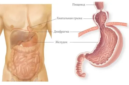 Грижа стравохідного отвору діафрагми симптоми, причини, лікування (стравохідного) Грижа стравохідного отвору діафрагми симптоми, причини, лікування