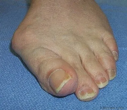 Hallux valgus - причини, симптоми, діагностика та лікування (причини) Hallux valgus - причини, симптоми, діагностика та лікування