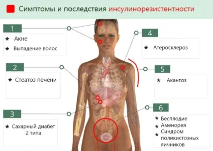 Інсулінорезистентність - симптоми, причини, дієта і лікування синдрому стійкості до дії