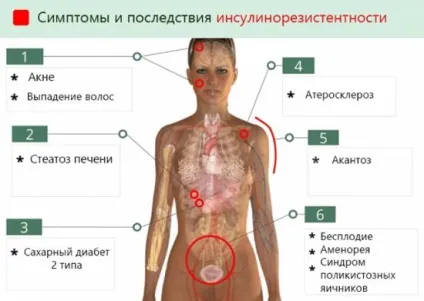 Інсулінорезистентність - симптоми, причини, дієта і лікування синдрому стійкості до дії