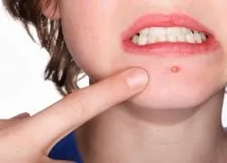 Іхтіолова мазь при фурункулах