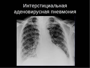 Інтерстиціальна пневмонія - симптоми і лікування (пневмонія) Інтерстиціальна пневмонія - симптоми і лікування