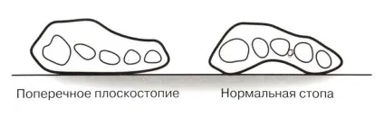 Виправлення плоскостопості хірургічним шляхом - клініка - союз (операція по виправленню плоскостопості) Виправлення плоскостопості хірургічним шляхом - клініка - союз