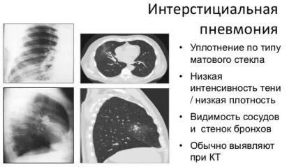 Інтерстиціальна пневмонія причини, симптоми, види, лікування (інтерстиціальна) Інтерстиціальна пневмонія причини, симптоми, види, лікування