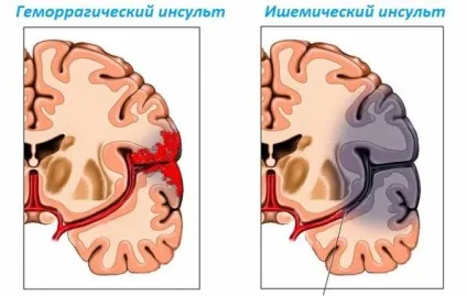 Ішемічний інсульт причини