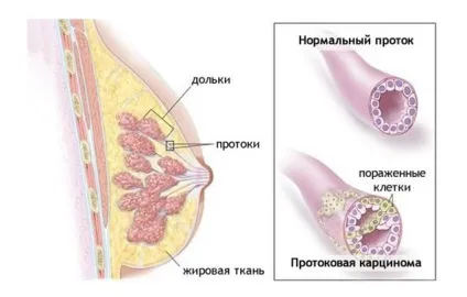 Інвазивний рак молочної залози симптоми протоковой карциноми, лікування, прогноз (симптоми) Інвазивний рак молочної залози симптоми протоковой карциноми, лікування, прогноз