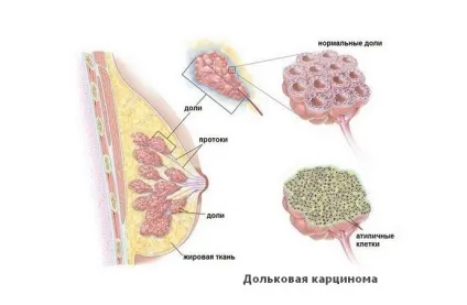 Інвазивний рак молочної залози симптоми протоковой карциноми, лікування, прогноз (протоковой) Інвазивний рак молочної залози симптоми протоковой карциноми, лікування, прогноз
