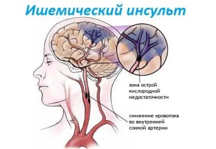 Ішемічний інсульт причини