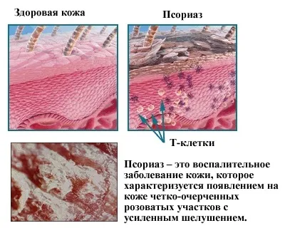 Як боротися з псоріазом - форми і симптоми захворювання (фото) (боротися) Як боротися з псоріазом - форми і симптоми захворювання (фото)