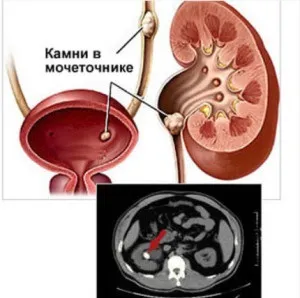 Які існують протипоказання при каменях у нирках