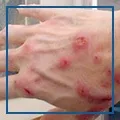 Як лікувати гайморит в домашніх умовах (домашніх) Як лікувати гайморит в домашніх умовах