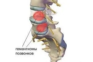 Як лікувати гемангиому хребта
