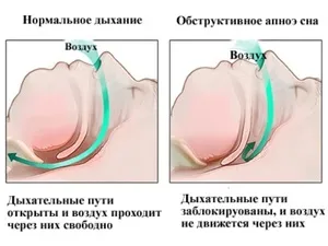 Як вилікуватися чоловікові, щоб позбутися уві сні від хропіння медикаментозне лікування і народні засоби (хропіння позбавлення лікування сон чоловік апное) Як вилікуватися чоловікові, щоб позбутися уві сні від хропіння медикаментозне лікування і народні засоби