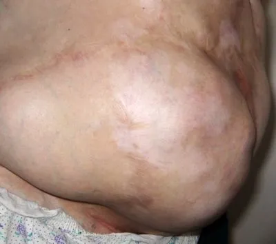 Як лікують грижу