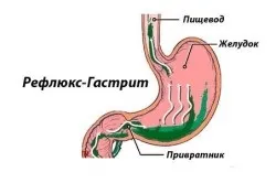 Як назавжди позбутися від печії (перший по стравоходу) Як назавжди позбутися від печії