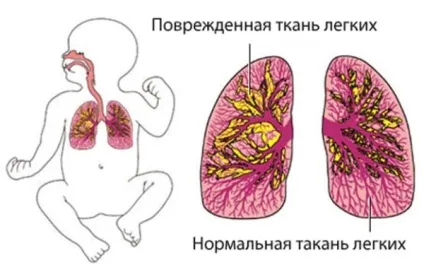 Як визначити запалення легенів у дітей симптоми, ознаки та лікування (запалення легенів у дітей симптоми і лікування) Як визначити запалення легенів у дітей симптоми, ознаки та лікування