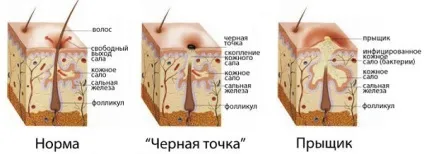 Як почистити ніс від чорних крапок в домашніх умовах