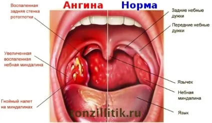 Як передається ангіна у дітей і дорослих (дітей) Як передається ангіна у дітей і дорослих