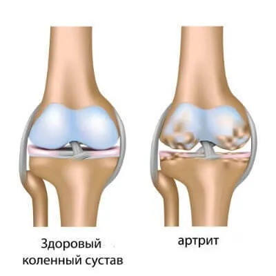 Як зміцнити зв'язки колінного суглоба - вправи і харчування (зміцнити) Як зміцнити зв'язки колінного суглоба - вправи і харчування