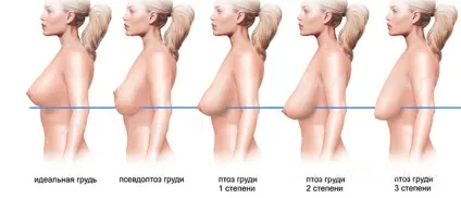 Як відновити форму і пружність грудей після пологів і годування (відновити) Як відновити форму і пружність грудей після пологів і годування