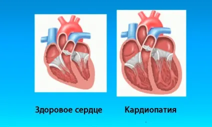 Кардіопатія у дітей - причини і лікування функціональної, вторинної та вродженої патології (дітей) Кардіопатія у дітей - причини і лікування функціональної, вторинної та вродженої патології
