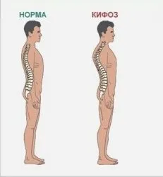 Кіфоз симптоми, види та методи лікування цієї хвороби