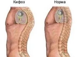 Кіфоз симптоми, види та методи лікування цієї хвороби