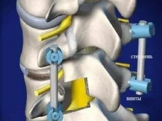 Кіфосколіоз грудного відділу хребта лікування, симптоми (грудного) Кіфосколіоз грудного відділу хребта лікування, симптоми