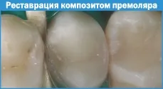 Композитні матеріали в стоматології