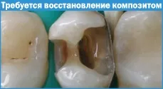 Композитні матеріали в стоматології