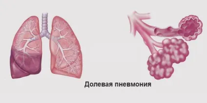 Крупозна пневмонія у дитини або дорослого - стадії і симптоми захворювання, діагностика і терапія (крупозна) Крупозна пневмонія у дитини або дорослого - стадії і симптоми захворювання, діагностика і терапія