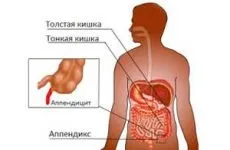 Лікування апендициту народними засобами без операції (апендициту) Лікування апендициту народними засобами без операції