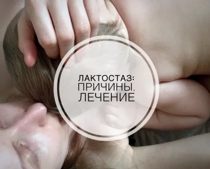 Лактостаз у годуючих