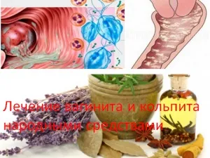 Лікування вагініту і кольпіту народними засобами, мій знахар (лікування кольпіту) Лікування вагініту і кольпіту народними засобами, мій знахар