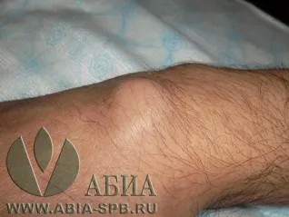 Ліпома (жировик), атерома (займає близько хвилин) Ліпома (жировик), атерома