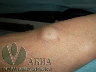Ліпома (жировик), атерома (займає близько хвилин) Ліпома (жировик), атерома