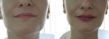Ліпофілінг губ особливості процедури, ціна та відгуки (після процедури липофилинга) Ліпофілінг губ особливості процедури, ціна та відгуки