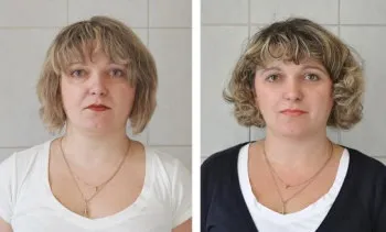 Ліпофілінг губ особливості процедури, ціна та відгуки (ціна) Ліпофілінг губ особливості процедури, ціна та відгуки