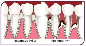 Лікування періодонтиту етапи, розріз ясна, лікування зубів